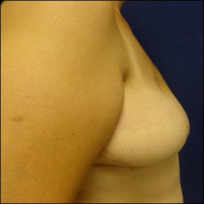 breast_reconstruction